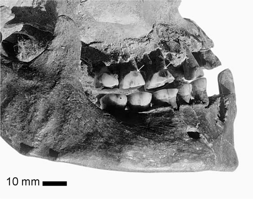 Perçage des dents paléolithiques